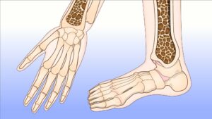 骨粗鬆症のイラスト