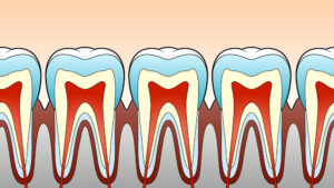 歯周病のイラスト