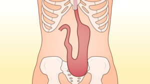 胃下垂の人の胃の位置