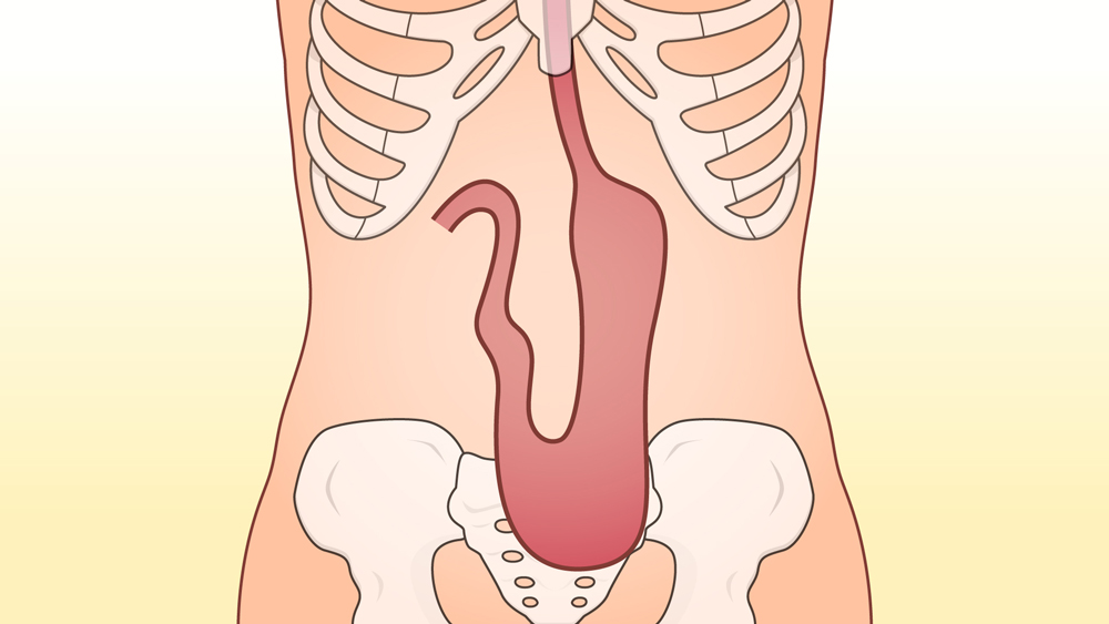 胃下垂の人の胃の位置